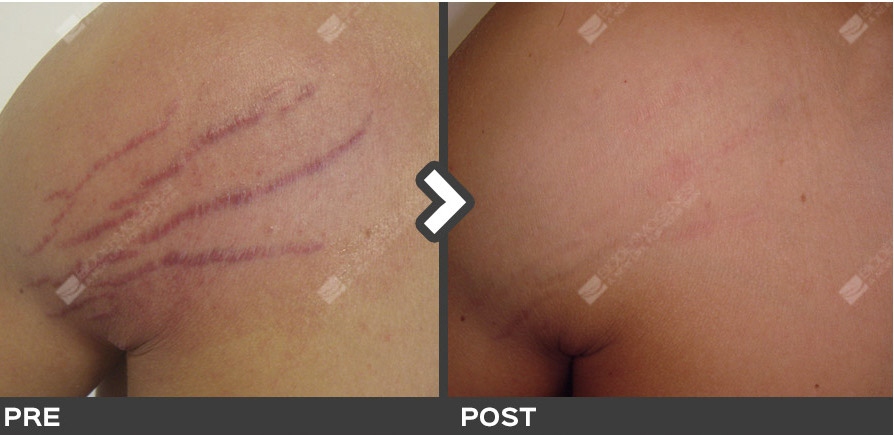 Brand-new treatment for stretch marks