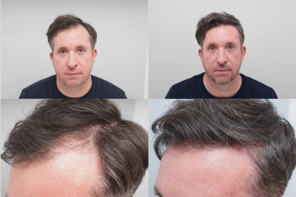Robbie Fowler reveals he's had a hair transplant to look like he did  towards the end of his playing career