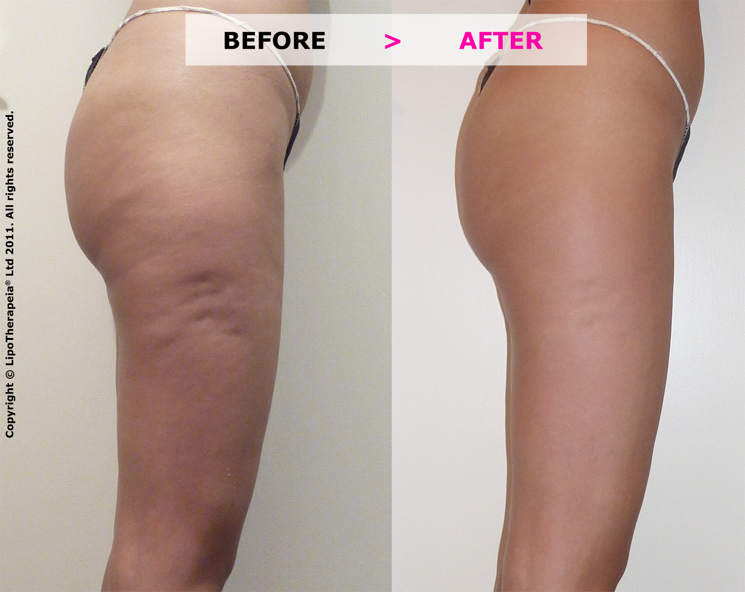 Attacking cellulite on 3 fronts with radiofrequency ...