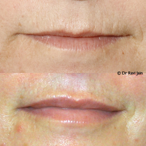 Give lips a natural look with Restylane