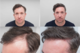 Robbie Fowler Hair Transplant Photos